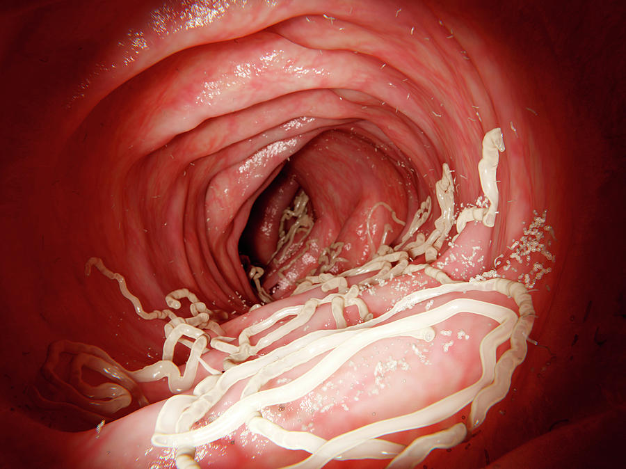 Roundworm Infection, Illustration Photograph by Juan Gaertner