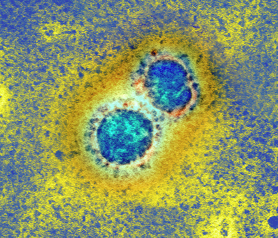 Coronavirus Photograph - Sars Virus Particles by A. Dowsett, Public Health England/science Photo Library