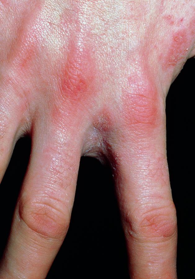 Scabies Infection On The Hand And Fingers Photograph by Dr H.c.robinson /  Science Photo Library - Fine Art America