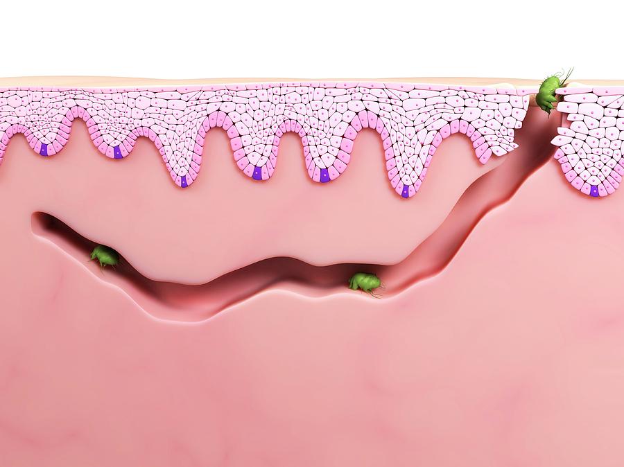Scabies Mites Photograph by Sciepro/science Photo Library Fine Art