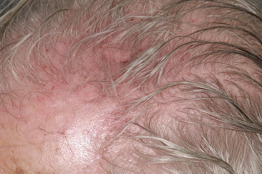 Scalp Irritation After Shingles Photograph By Dr P Marazziscience Photo Library 