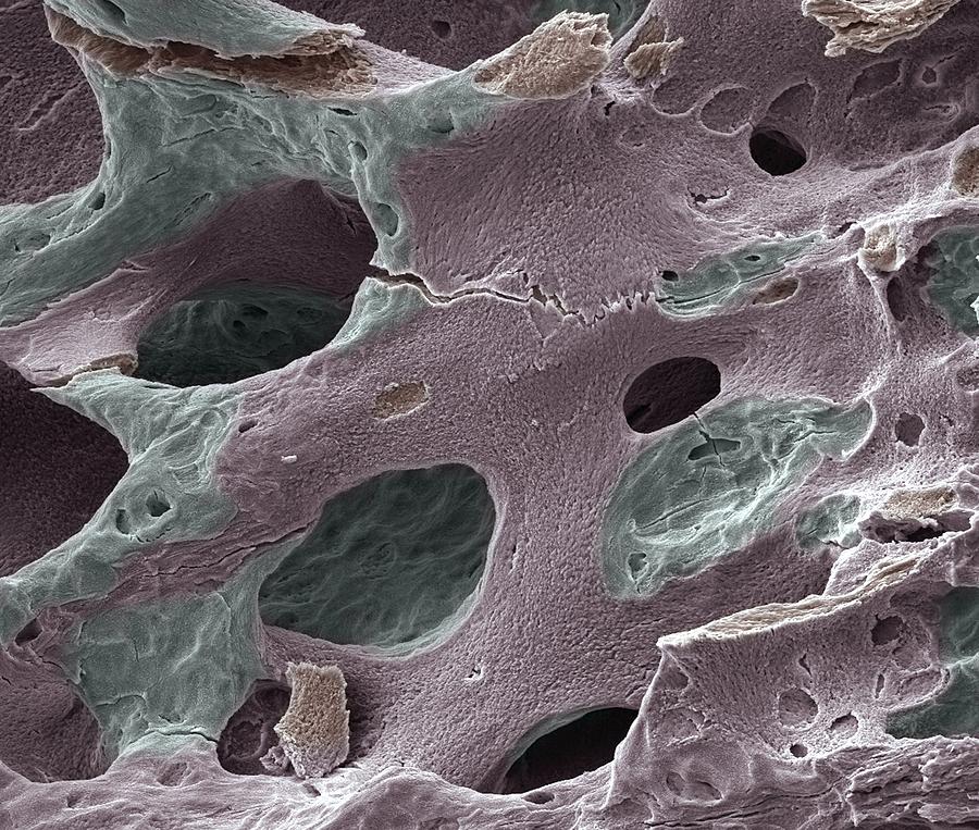 Scanning electron micrograph (SEM) of human bone, osteoporosis Photograph by Science Photo Library - STEVE GSCHMEISSNER.
