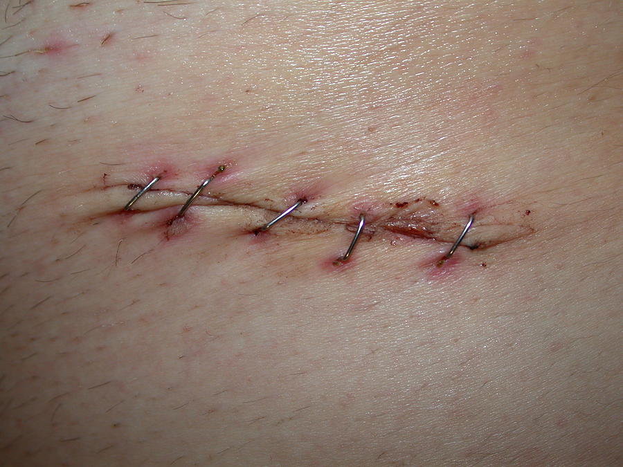 Scar of appendicitis Photograph by 1suisse.ch
