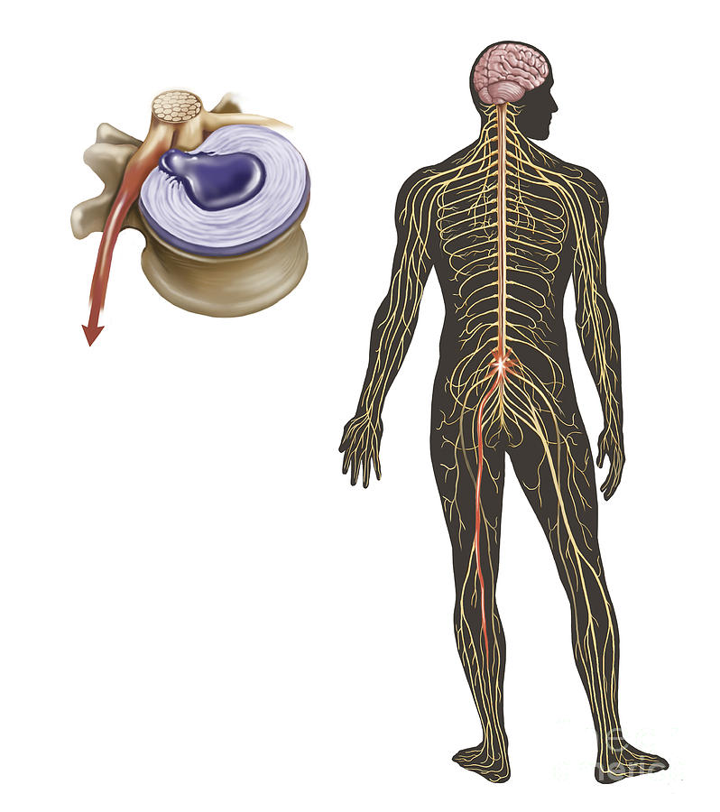 Illustration Digital Art - Sciatica Caused From Herniated Disc by TriFocal Communications