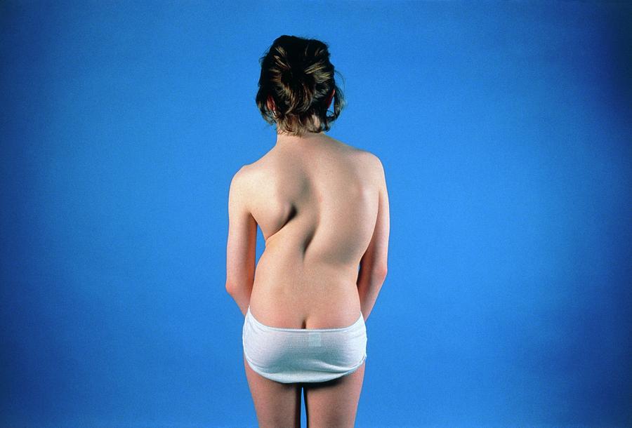 Scoliosis In An Adolescent Girl Photograph by Medical Photo Nhs Lothian/science Photo Library