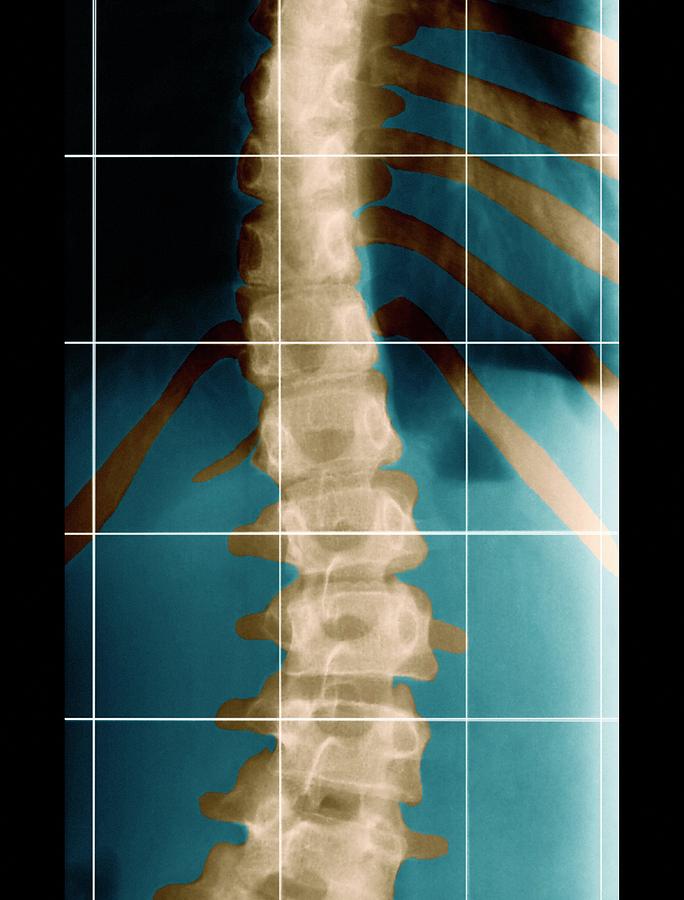 Scoliosis Photograph - Scoliosis Of The Back by Zephyr/science Photo Library