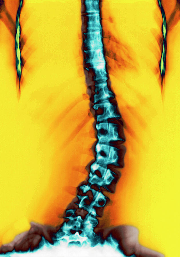 Scoliosis Of The Spine Photograph by Medical Photo Nhs Lothian/science Photo Library