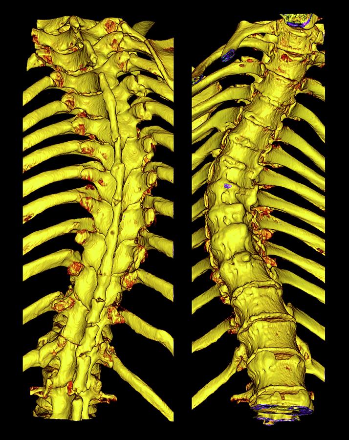 Scoliosis Photograph - Scoliosis Of The Thoracic Spine by K H Fung/science Photo Library