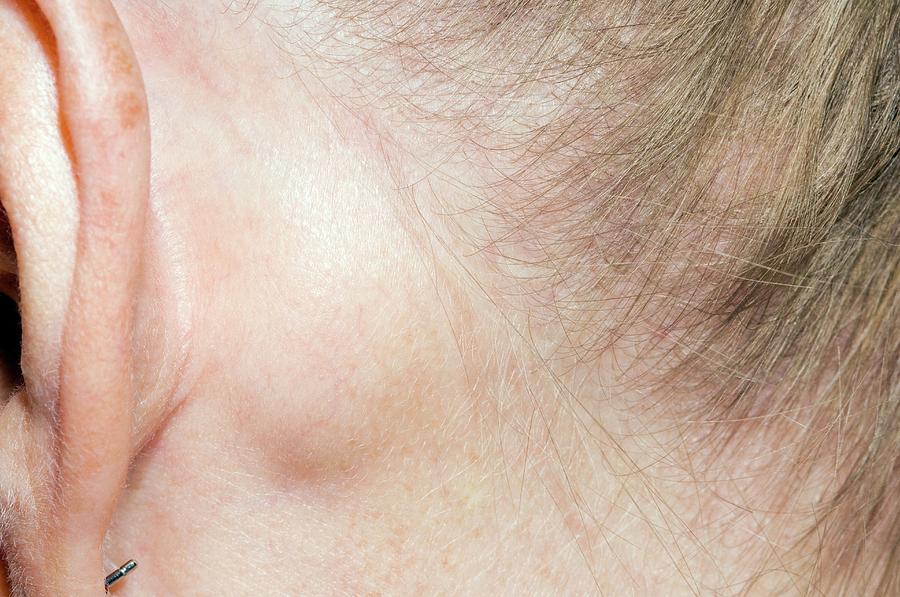Sebaceous Cyst Behind The Ear Photograph By Dr P Marazzi science Photo 