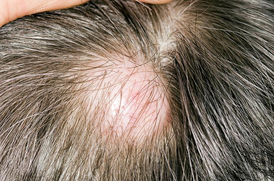 Sebaceous Cyst On The Scalp Photograph By Dr P Marazzi science Photo 