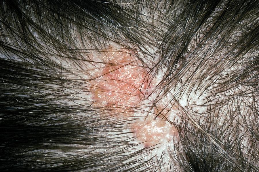 Sebaceous Naevus On The Scalp Photograph by Dr P. Marazzi/science Photo