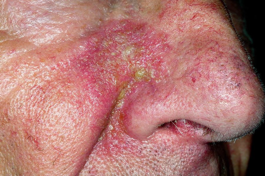 Seborrheic Dermatitis On The Nose Photograph By Dr P Marazziscience Photo Library