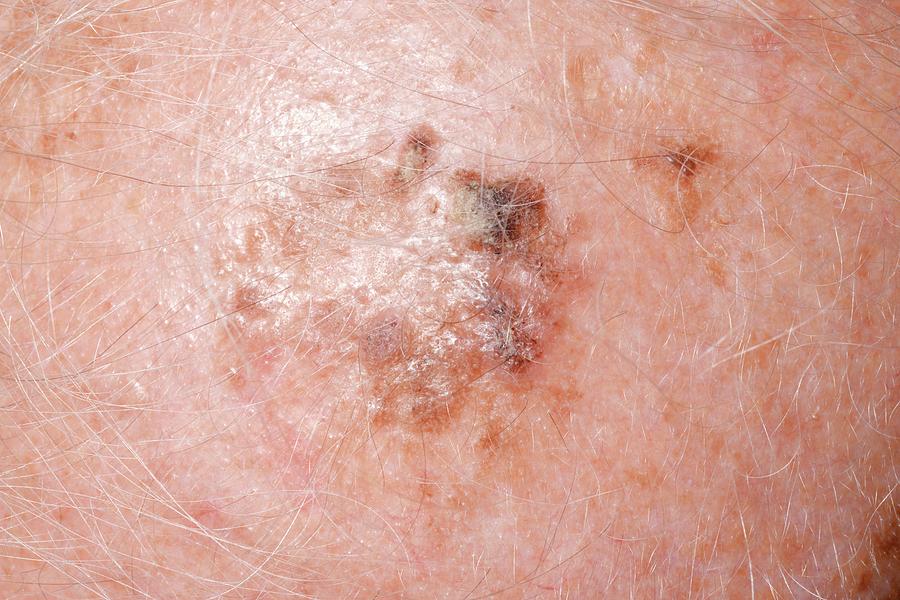 Seborrheic Keratosis Photograph By Dr P Marazziscience Photo Library