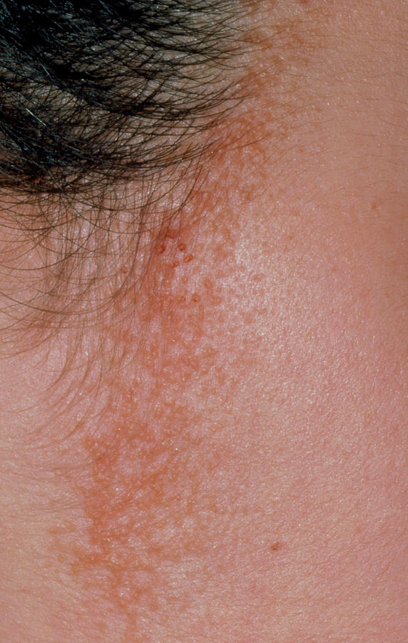 Seborrhoeic Dermatitis Around Hairline Photograph By Dr P Marazzi Science Photo Library