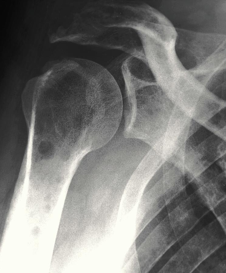 Secondary Bone Cancer Photograph By Zephyrscience Photo Library Pixels