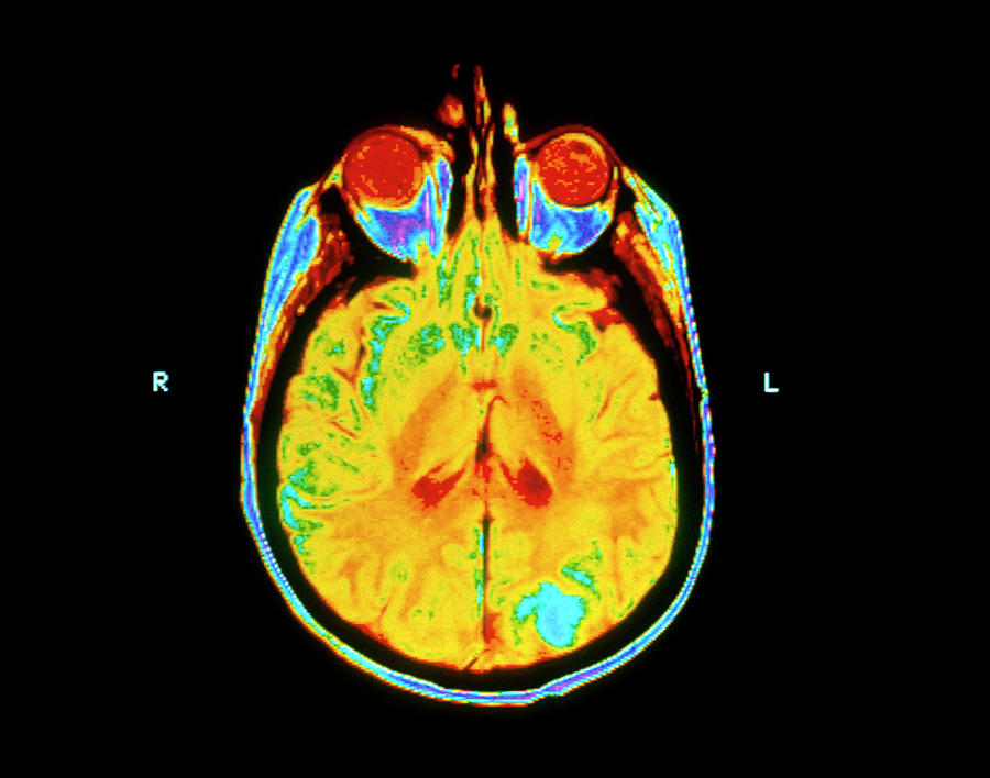 secondary-brain-cancer-photograph-by-national-cancer-institute-science