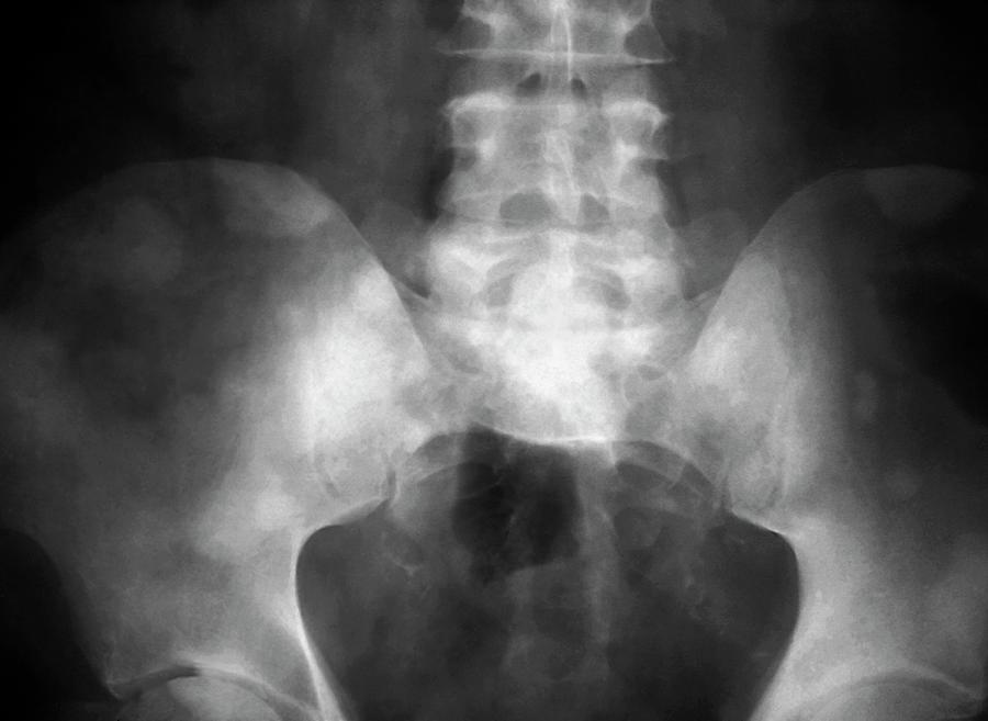 Secondary Cancer In The Pelvis Photograph By Zephyrscience Photo Library 