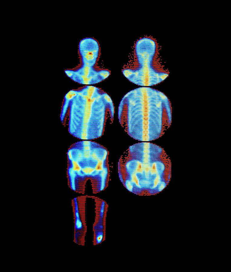 Secondary Cancer Photograph By Simon Fraser/medical Physics, Rvi ...