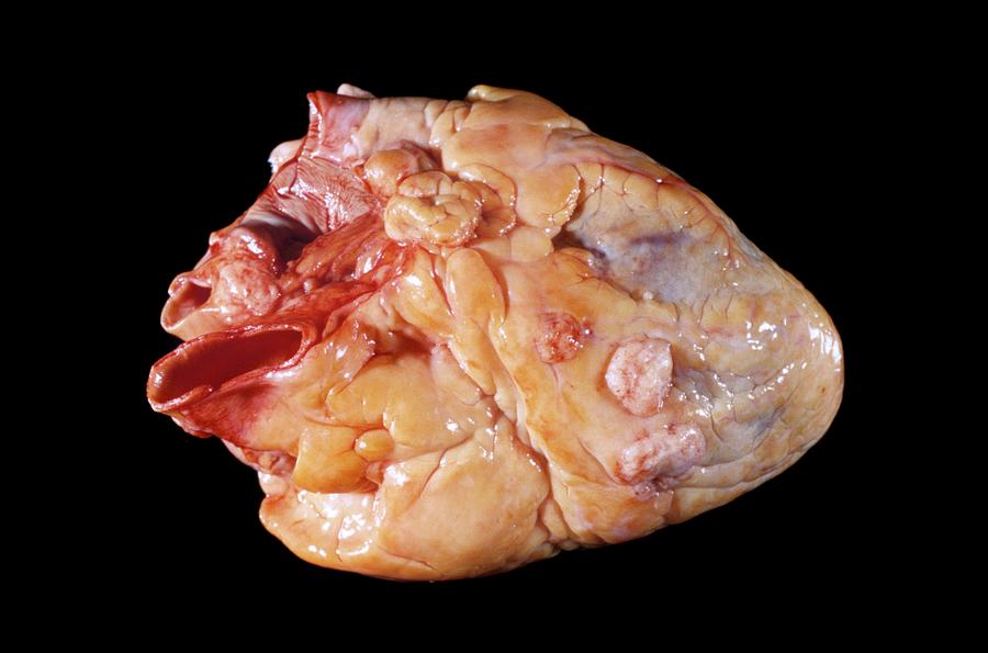Secondary Heart Cancer Photograph by Pr. M. Forest - Cnri