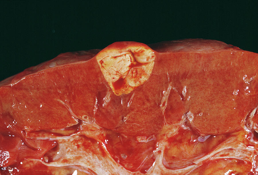 Secondary Kidney Cancer Photograph by Cnri/science Photo Library
