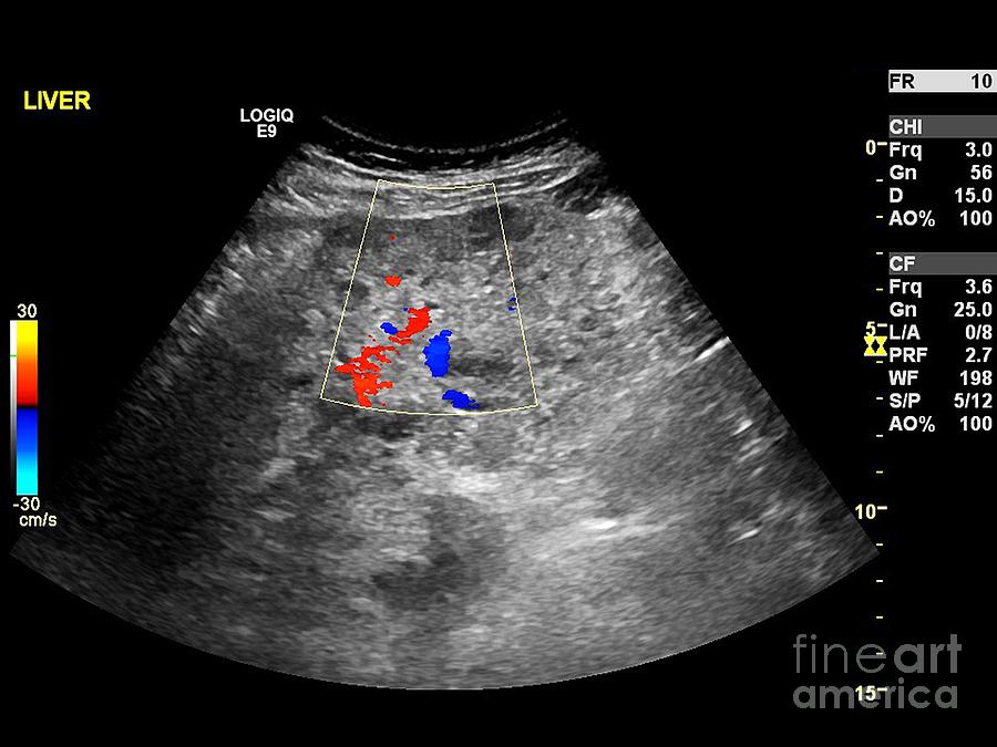 Secondary Liver Cancer, Ultrasound Scan Photograph by Science Photo ...