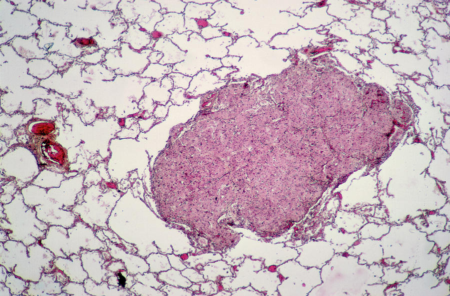 Secondary Lung Cancer Photograph by Cnri/science Photo Library | Fine ...