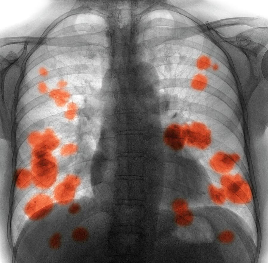 Secondary Lung Cancer Photograph by Science Photo Library