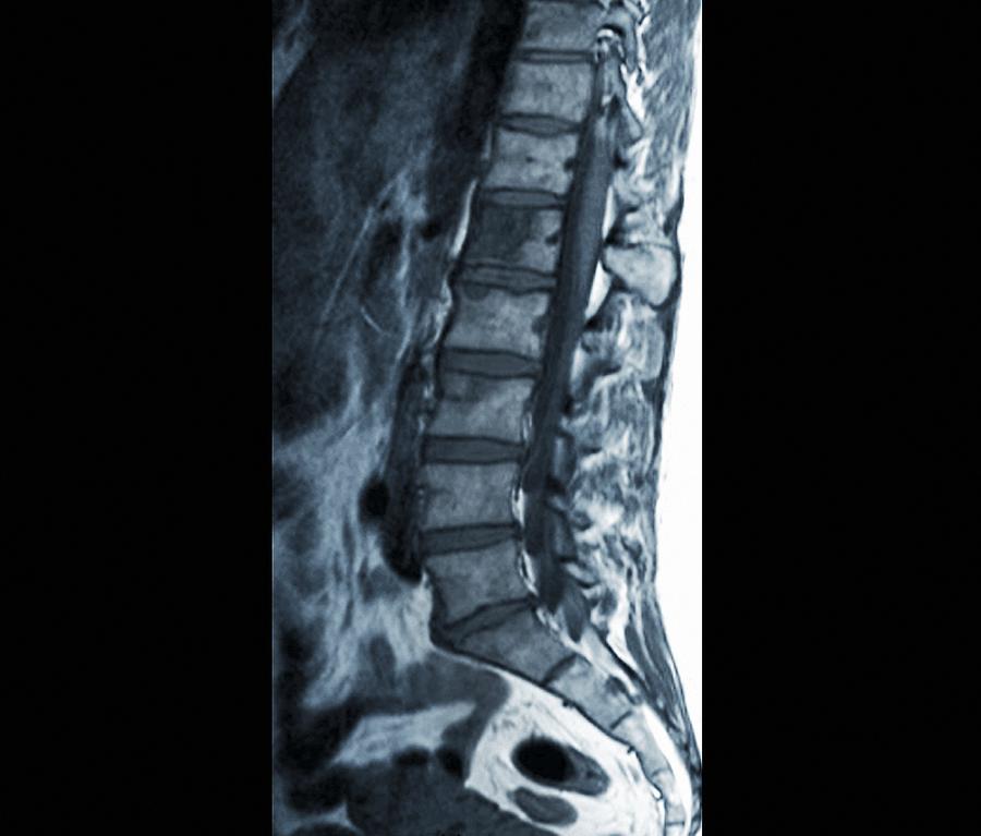 Black And White Photograph - Secondary spinal cancer, MRI scan by Science Photo Library