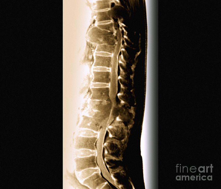 Mri Lumbar Spine Cancer