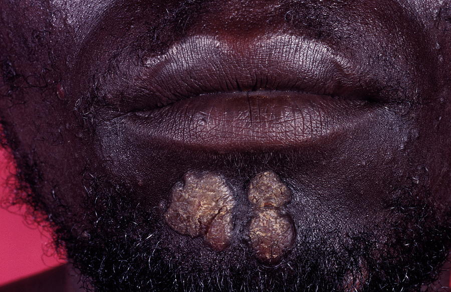 Secondary Syphilis Photograph by Dr M.a. Ansary/science Photo Library