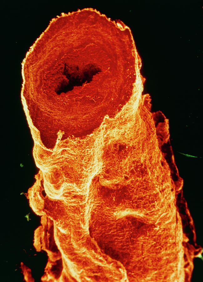 Sectioned Varicose Saphenous Vein Photograph by Alain Pol, Ism/science ...