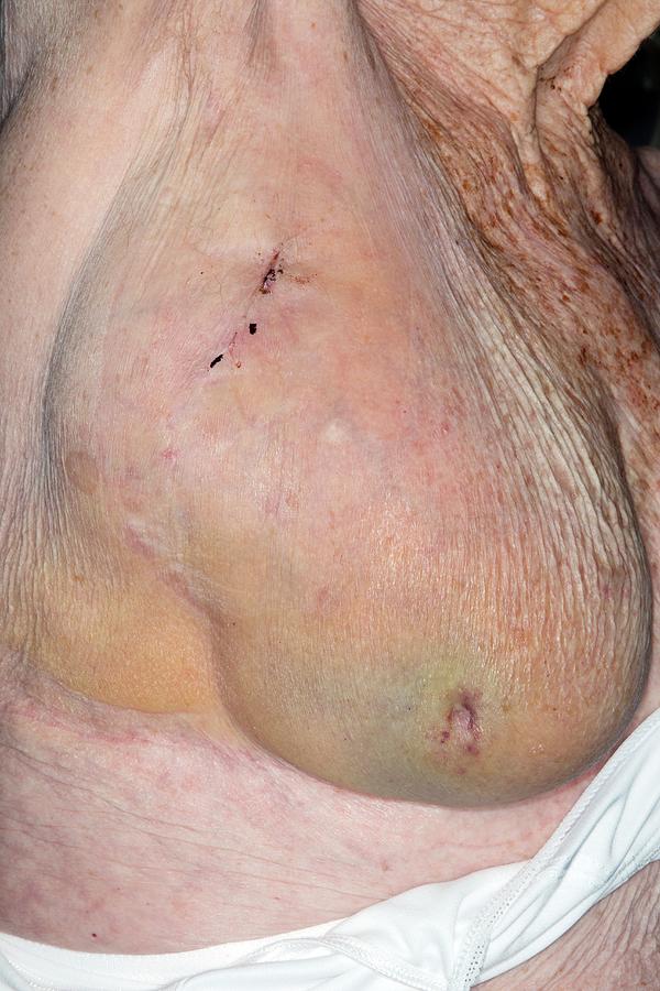 Seroma After Breast Surgery Photograph By Dr P Marazzi Science Photo Library