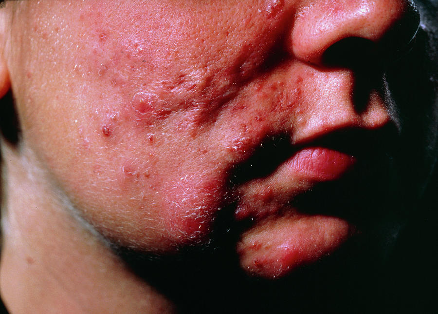 Severe Acne Scarring Over An Adolescent Boy s Face Photograph By Eamonn 