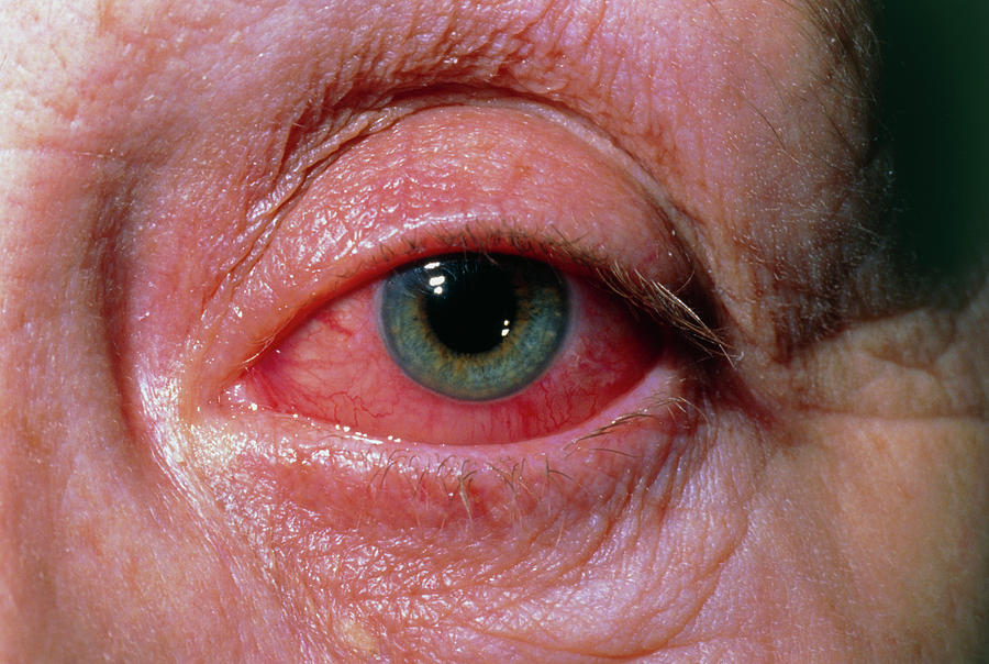 Severe Allergic Conjunctivitis Photograph By Dr Hcrobinson Science Photo Library Fine Art 