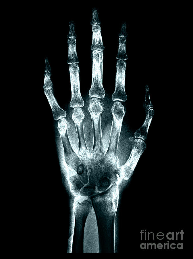 Severe Osteoporosis, X-ray Photograph by Living Art Enterprises