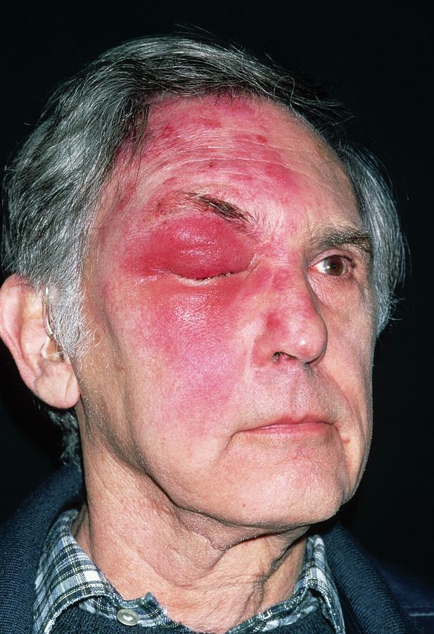 Shingles Attack On Head Of Elderly Male Photograph by Dr P. Marazzi ...