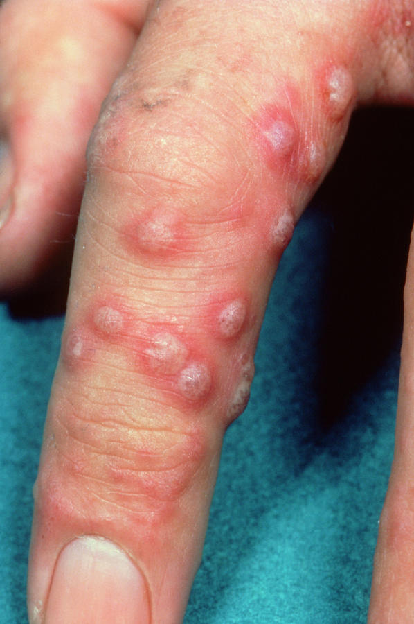 Varicella Zoster Photograph - Shingles Caused By Virus Herpes Zoster by James Stevenson/science Photo Library