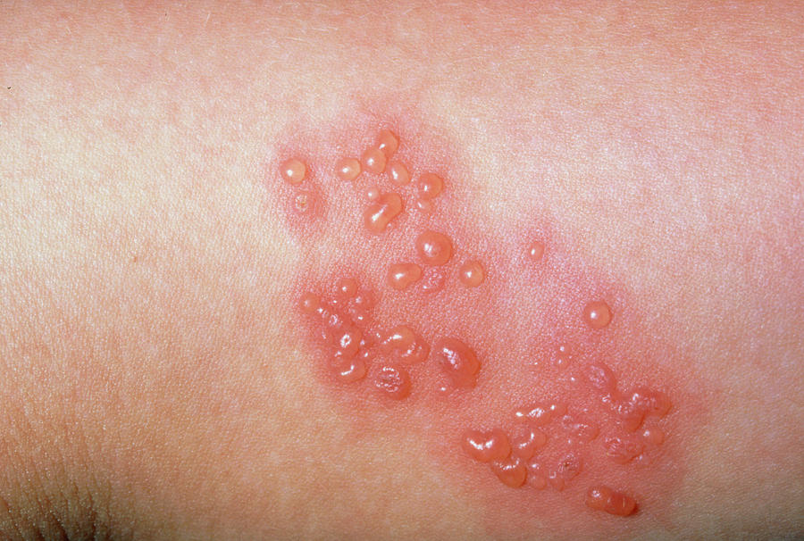 Shingles Close Up Of Blisters Photograph By Dr P Marazziscience Photo Library 2830