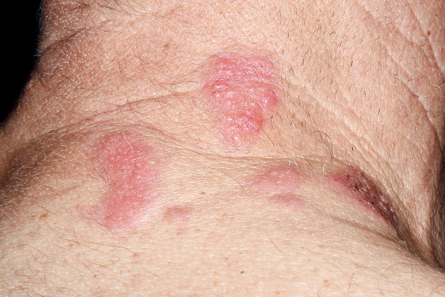 Back Pain And Shingles Hot Sex Picture