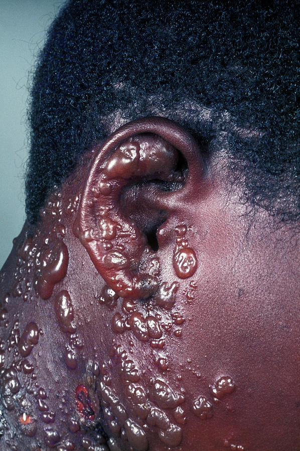 Shingles Photograph - Shingles Rash In An Hiv Patient by Dr M.a. Ansary/science Photo Library