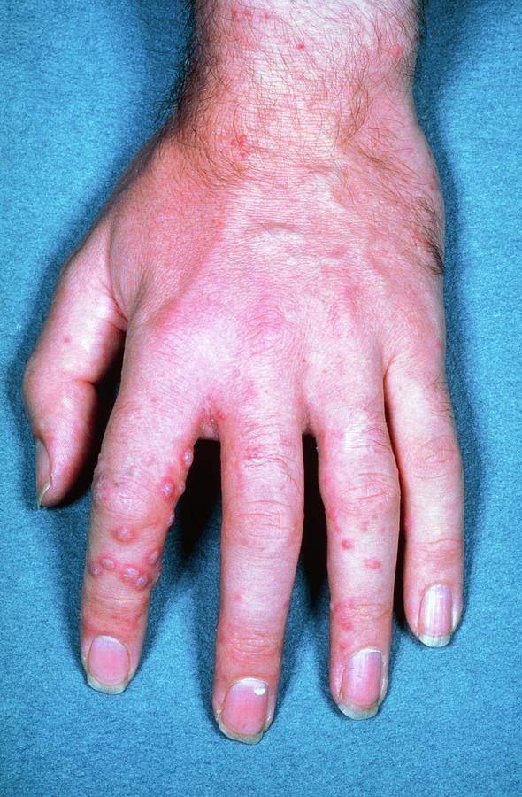 Blister Photograph - Shingles Rash On Hand by James Stevenson/science Photo Library