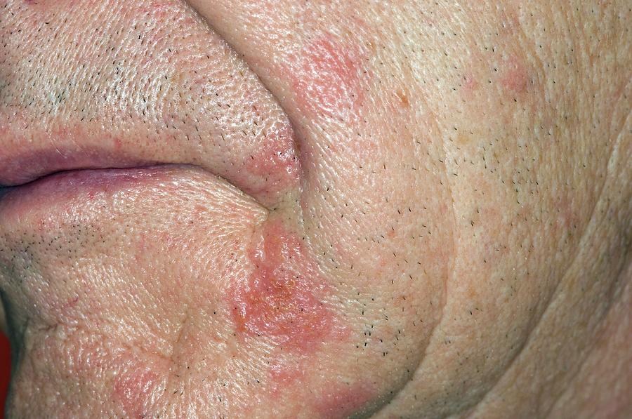 Shingles Rash On The Face Photograph by Dr P. Marazzi/science Photo Library