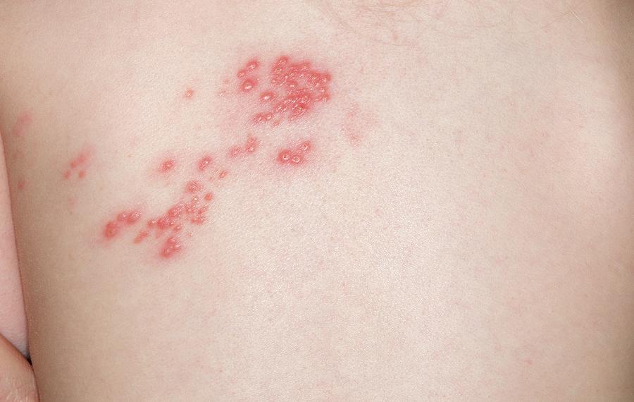 Shingles Rash On The Skin Photograph by Dr P. Marazzi/science Photo Library