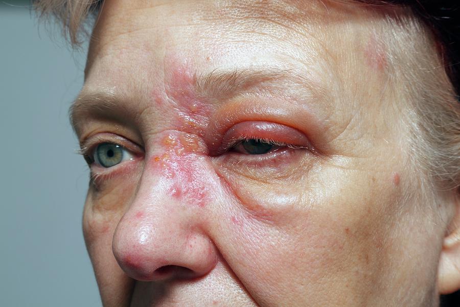 Face Photograph - Shingles Rash by Victor De Schwanberg/science Photo Library