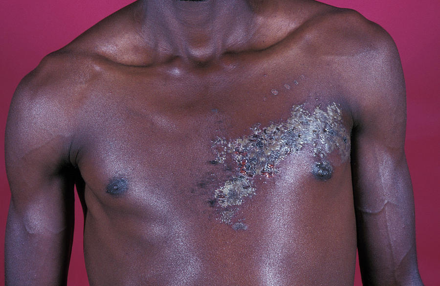 Shingles Skin Rash By Dr Ma Ansaryscience Photo Library