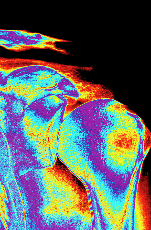 Shoulder Joint X-ray Photograph by Alfred Pasieka/science Photo Library