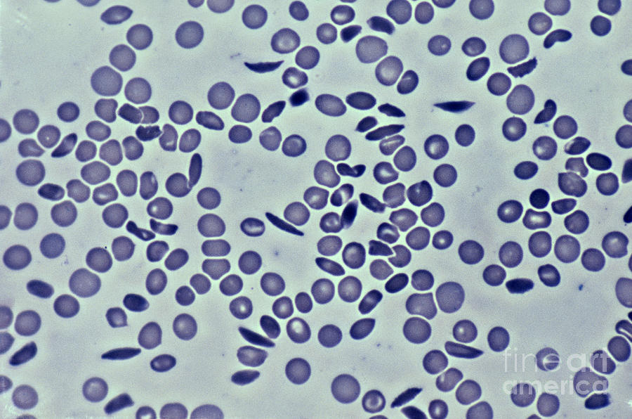 Sickle Cell Anemia Photograph by Biology Pics