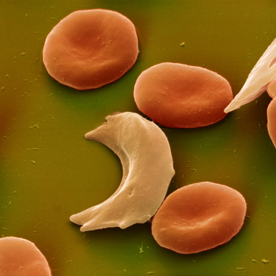 Sickle Cell Anemia Photograph by Eye of Science