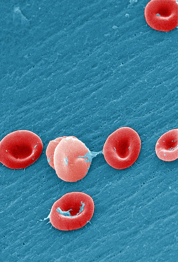 Sickle Cell Anemia, Human Rbcs, Sem Photograph by Science Source