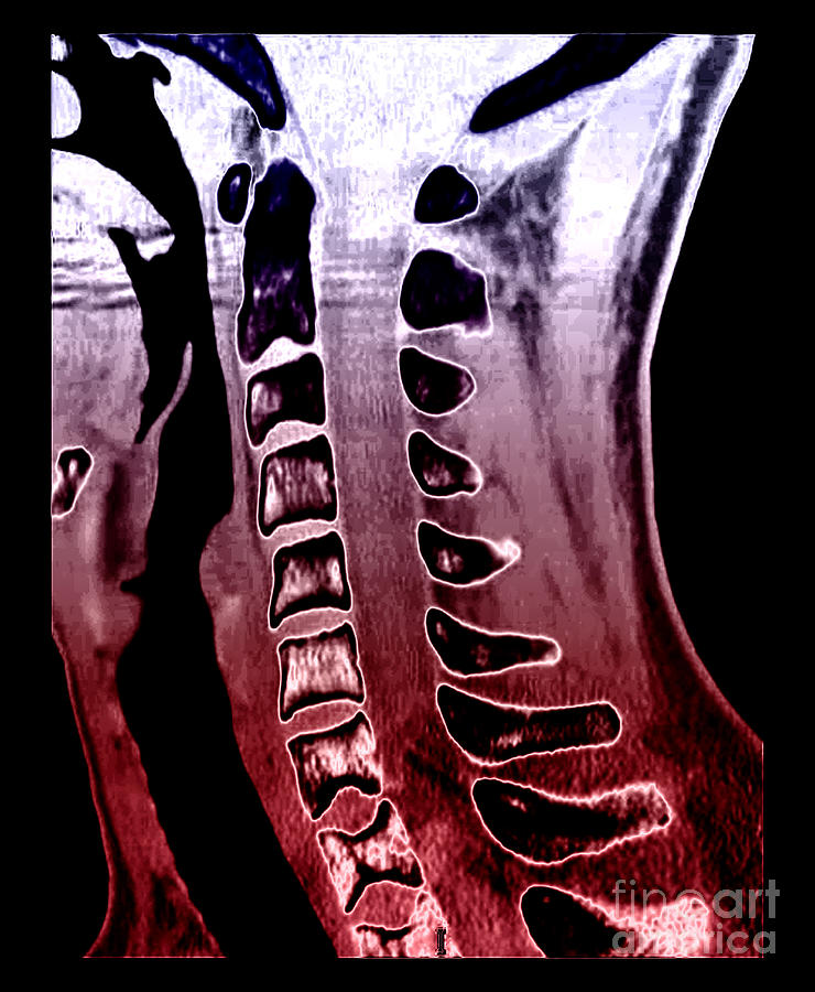 Sickle Cell Osteopathy, Ct Scan Photograph by Living Art Enterprises